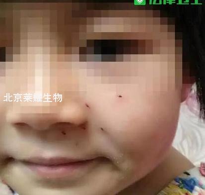 女童臉被老師扎洞